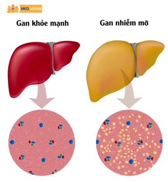 Xét nghiệm máu cho biết bệnh lý gan