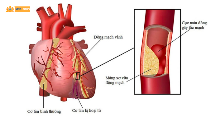 Xét nghiệm máu cho biết bệnh lý tim mạch