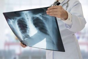 Chụp X Quang ngực