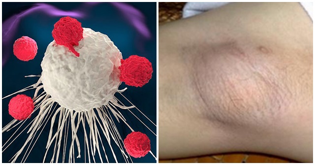 Sưng hạch ở nách