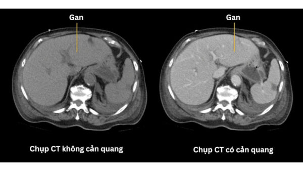 So sánh hình ảnh MRI khi sử dụng và không sử dụng thuốc cản quang
